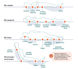 Профилактика пролежней: какие средства помогут